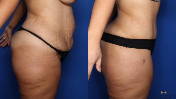 Before & After Liposuction Case 382 Right Side View in Fort Worth & Arlington, Texas