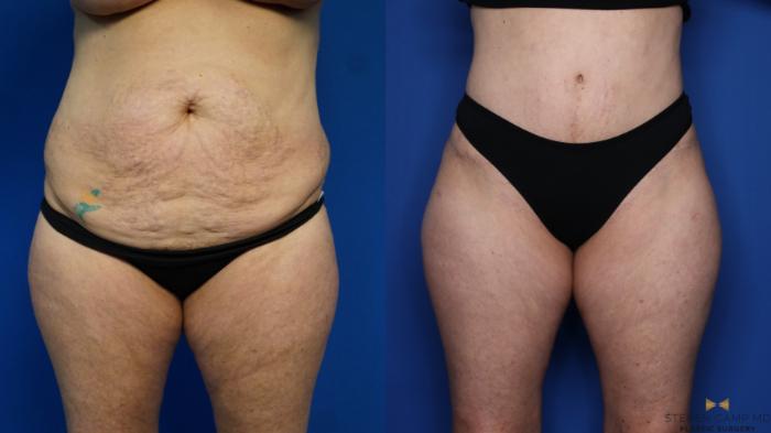 Before & After Tummy Tuck Case 383 Front View in Fort Worth & Arlington, Texas