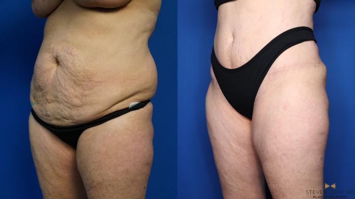 Before & After Tummy Tuck Case 383 Left Oblique View in Fort Worth & Arlington, Texas