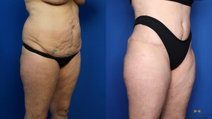 Before & After Tummy Tuck Case 383 Right Oblique View in Fort Worth & Arlington, Texas