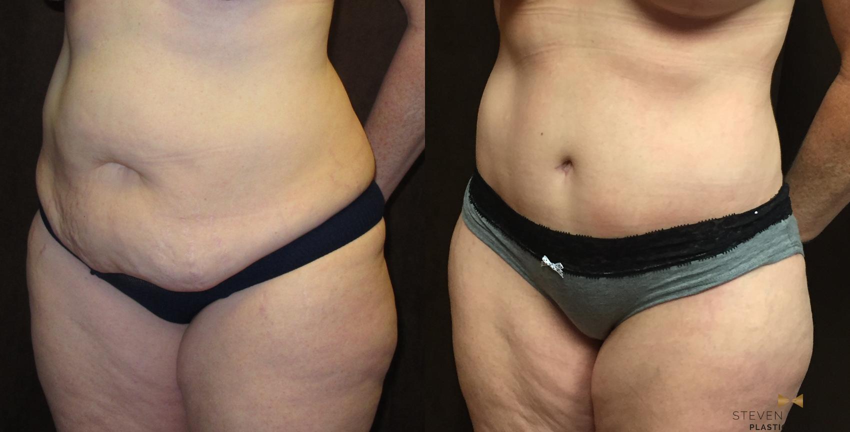 At 46 This Mother Of 2 Looks Great After Tummy Tuck And Liposuction Surgery...