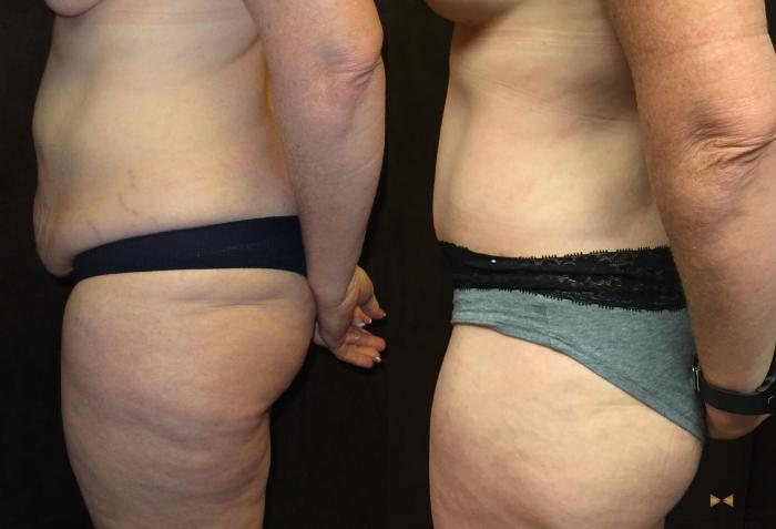 Before & After Tummy Tuck Case 39 View #3 View in Fort Worth & Arlington, Texas