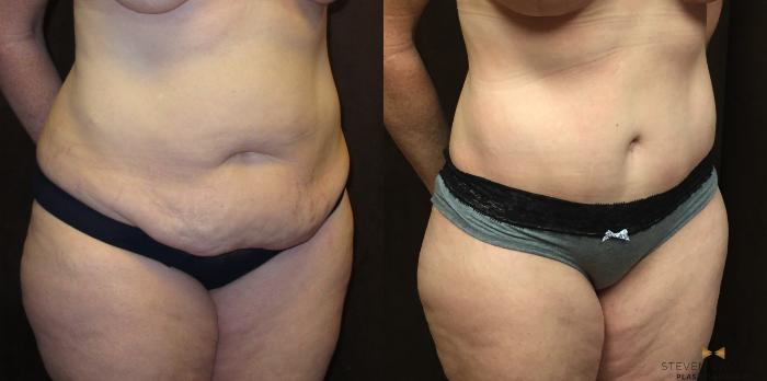 Before & After Tummy Tuck Case 39 View #4 View in Fort Worth & Arlington, Texas