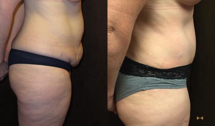 Before & After Tummy Tuck Case 39 View #5 View in Fort Worth & Arlington, Texas