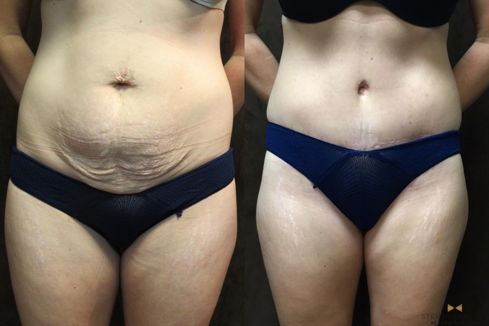 Before & After Tummy Tuck Case 40 View #1 View in Fort Worth, Texas