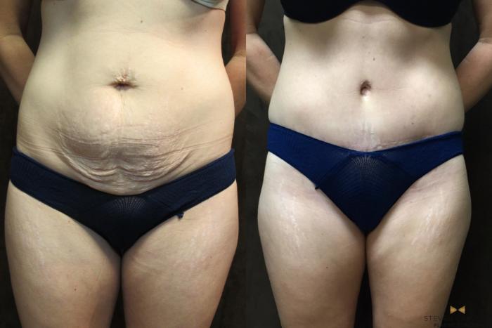 Before & After Tummy Tuck Case 40 View #1 View in Fort Worth & Arlington, Texas