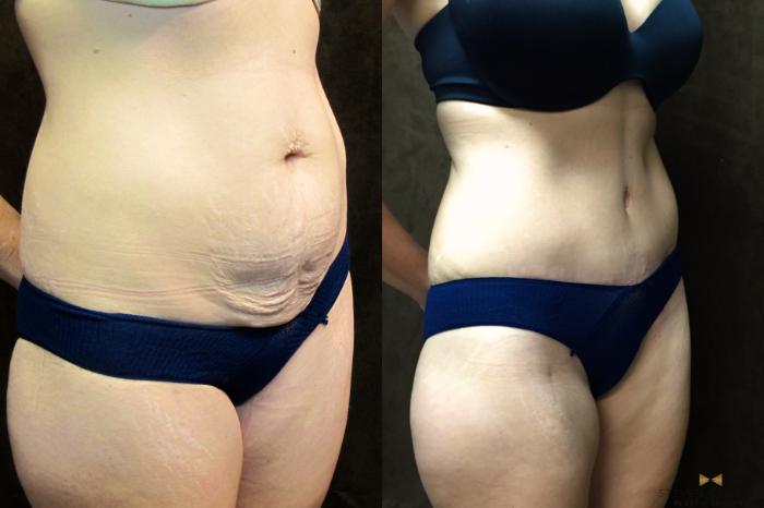 Before & After Tummy Tuck Case 40 View #2 View in Fort Worth & Arlington, Texas