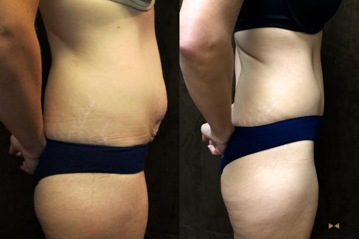 Before & After Tummy Tuck Case 40 View #3 View in Fort Worth & Arlington, Texas