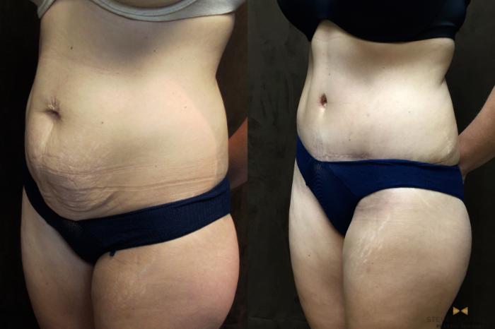 Before & After Tummy Tuck Case 40 View #4 View in Fort Worth & Arlington, Texas