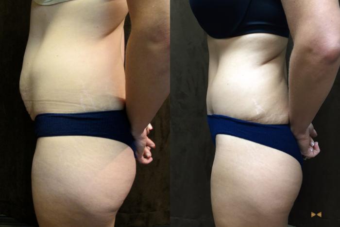 Before & After Tummy Tuck Case 40 View #5 View in Fort Worth & Arlington, Texas