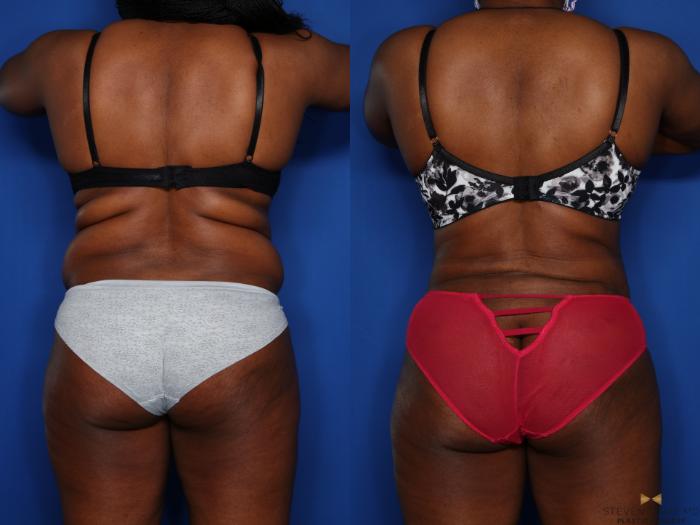 Before & After Tummy Tuck Case 406 Back View in Fort Worth & Arlington, Texas