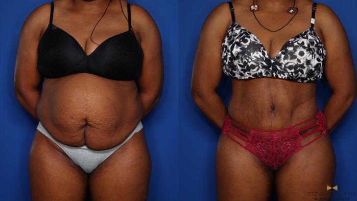 Before & After Tummy Tuck Case 406 Front View in Fort Worth & Arlington, Texas