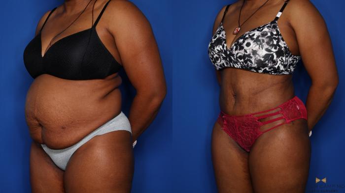 Before & After Liposuction Case 406 Left Oblique View in Fort Worth & Arlington, Texas
