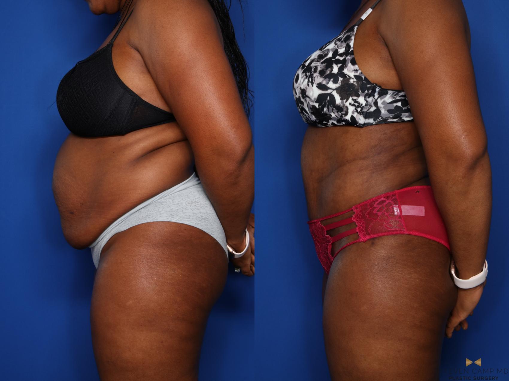 Before & After Liposuction Case 406 Left Side View in Fort Worth & Arlington, Texas