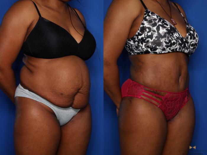 Before & After Liposuction Case 406 Right Oblique View in Fort Worth & Arlington, Texas