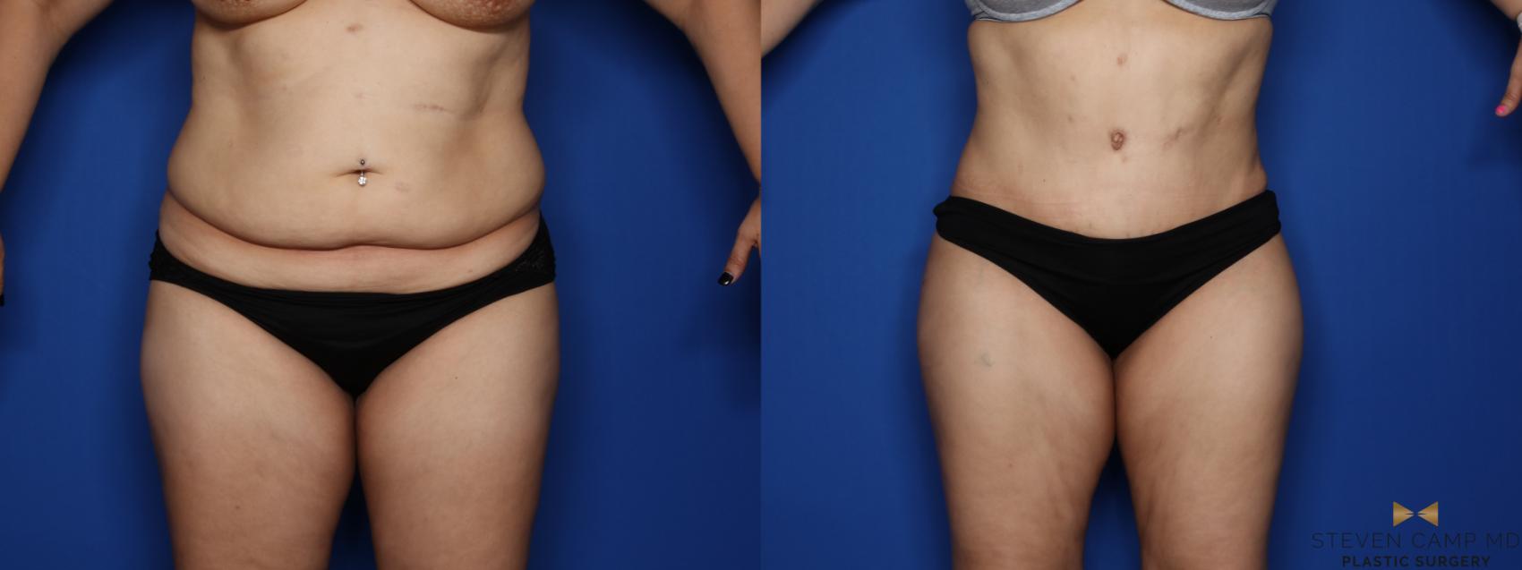 Before & After Liposuction Case 408 Front View in Fort Worth & Arlington, Texas