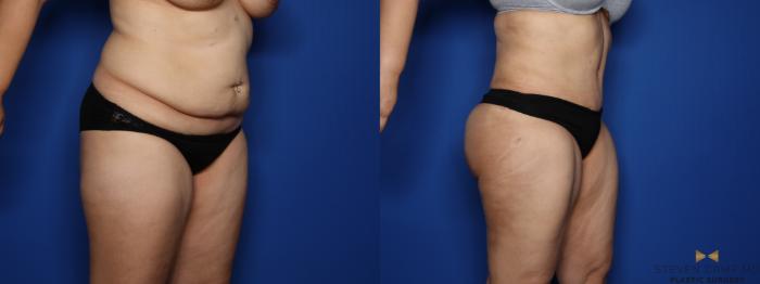 Before & After Liposuction Case 408 Left Oblique View in Fort Worth & Arlington, Texas