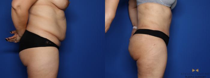Before & After Tummy Tuck Case 408 Left Side View in Fort Worth & Arlington, Texas