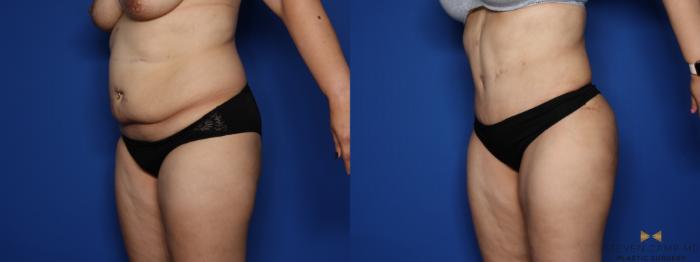 Before & After Liposuction Case 408 Right Oblique View in Fort Worth & Arlington, Texas