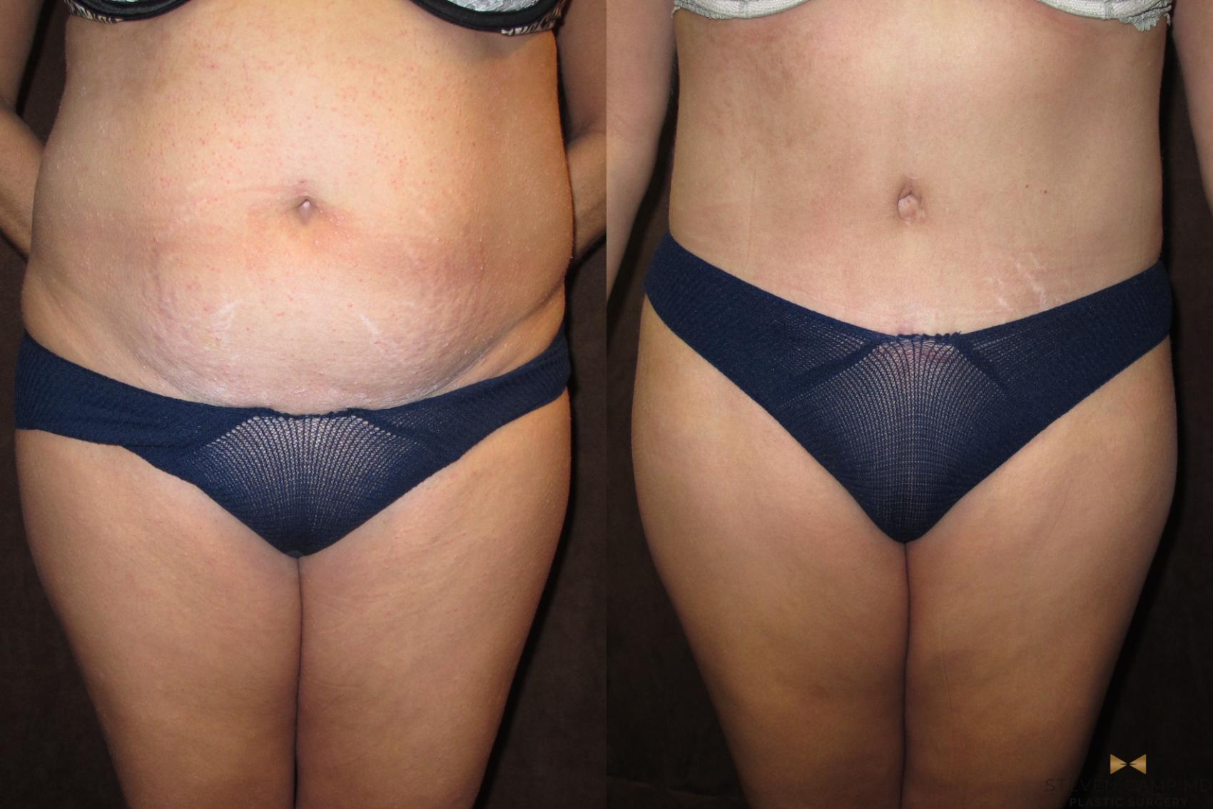 Before & After Tummy Tuck Case 41 View #1 View in Fort Worth, Texas