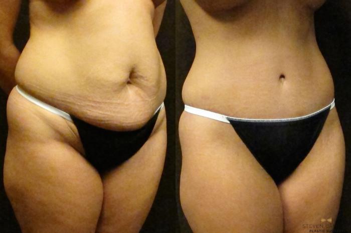 Tummy Tuck Case #42