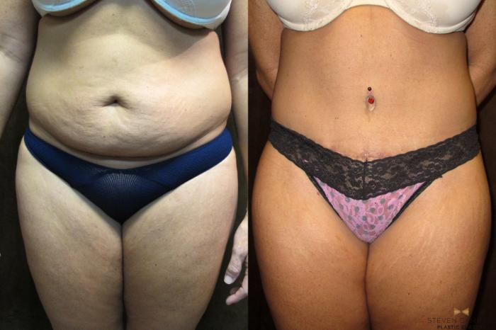 Before & After Tummy Tuck Case 43 View #1 View in Fort Worth, Texas