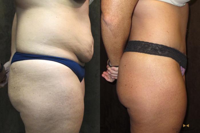 Before & After Tummy Tuck Case 43 View #3 View in Fort Worth, Texas