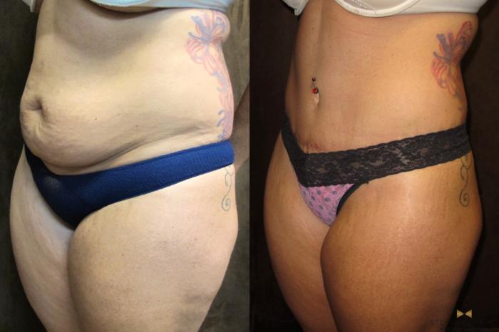 Before & After Tummy Tuck Case 43 View #4 View in Fort Worth, Texas