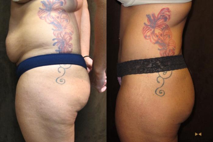 Before & After Tummy Tuck Case 43 View #5 View in Fort Worth, Texas