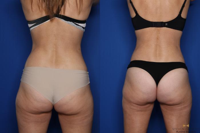 Before & After Liposuction Case 431 Back View in Fort Worth & Arlington, Texas