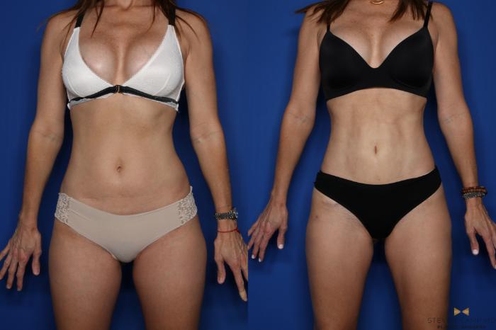 Before & After Tummy Tuck Case 431 Front View in Fort Worth & Arlington, Texas