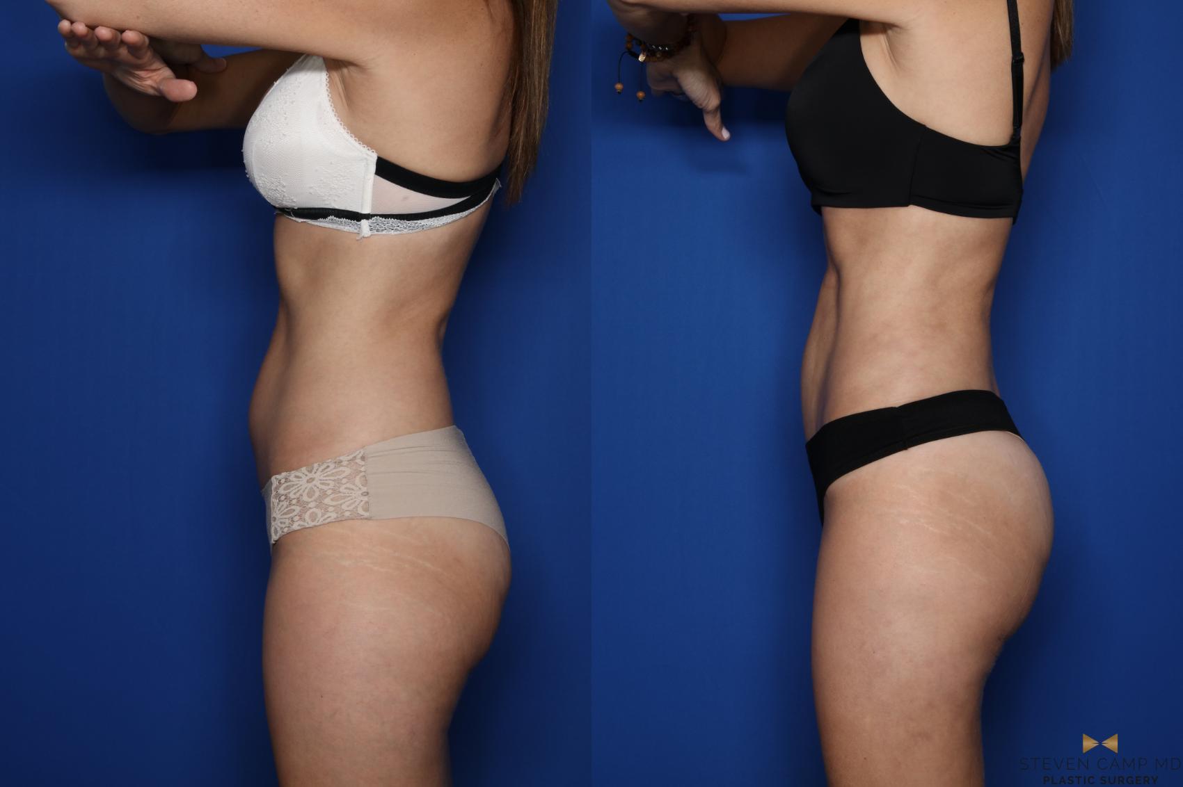Before & After Tummy Tuck Case 431 Left Side View in Fort Worth & Arlington, Texas