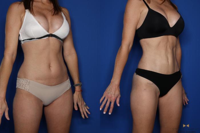 Before & After Tummy Tuck Case 431 Right Oblique View in Fort Worth & Arlington, Texas