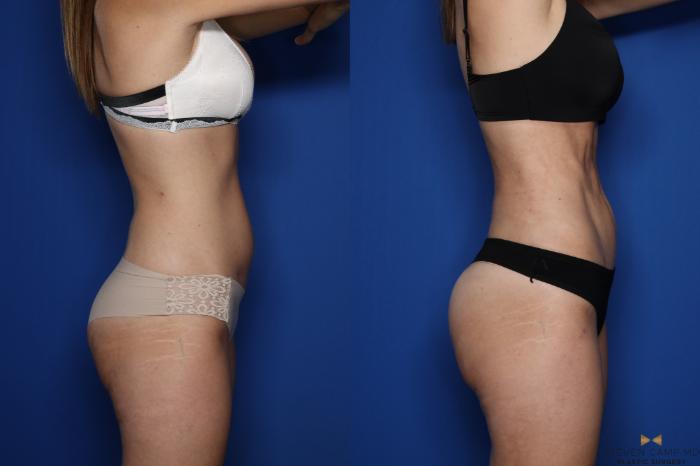 Before & After Tummy Tuck Case 431 Right Side View in Fort Worth & Arlington, Texas