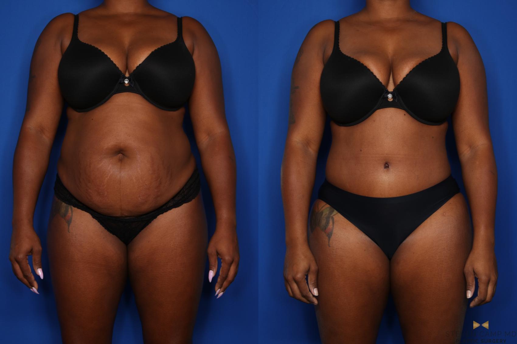 Before & After Tummy Tuck Case 432 Front View in Fort Worth & Arlington, Texas