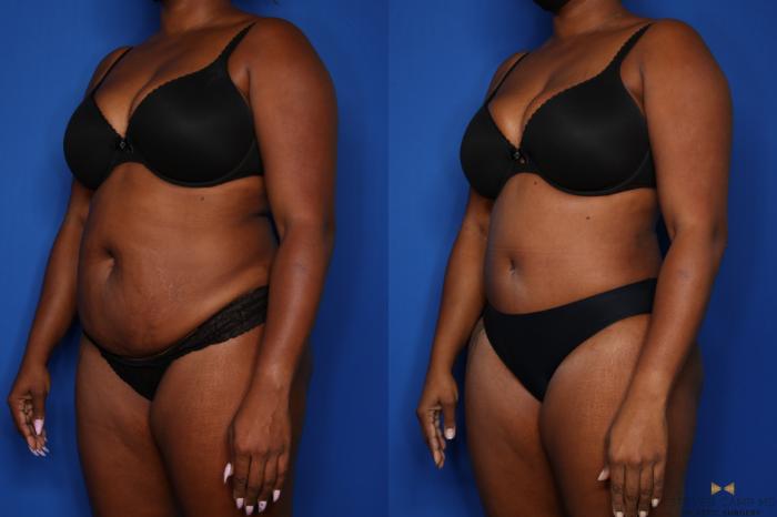 Before & After Tummy Tuck Case 432 Left Oblique View in Fort Worth & Arlington, Texas