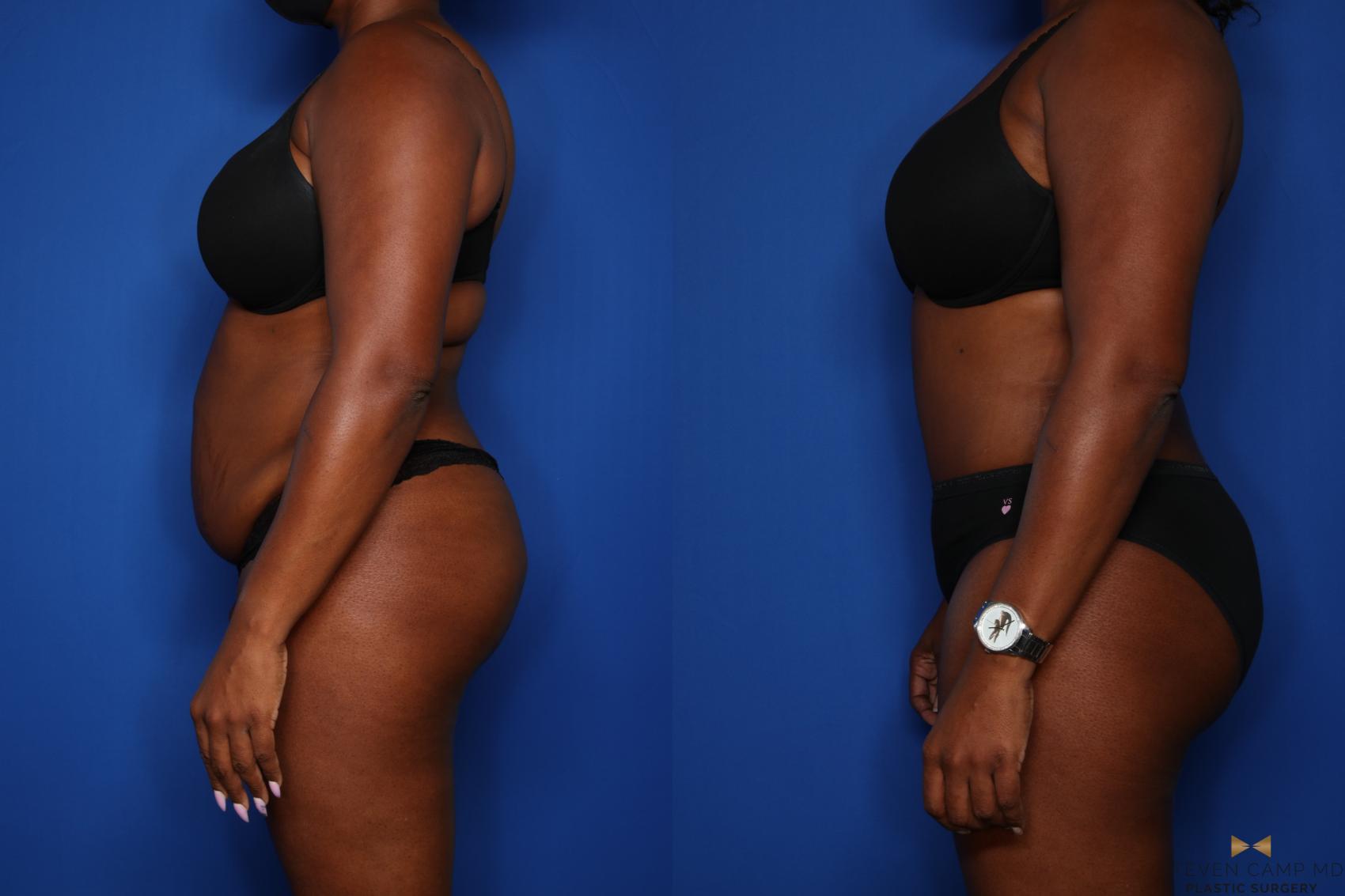 Before & After Tummy Tuck Case 432 Left Side View in Fort Worth & Arlington, Texas