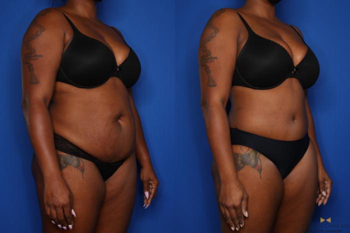 Before & After Tummy Tuck Case 432 Right Oblique View in Fort Worth & Arlington, Texas
