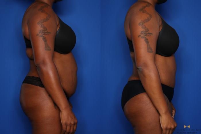 Before & After Tummy Tuck Case 432 Right Side View in Fort Worth & Arlington, Texas