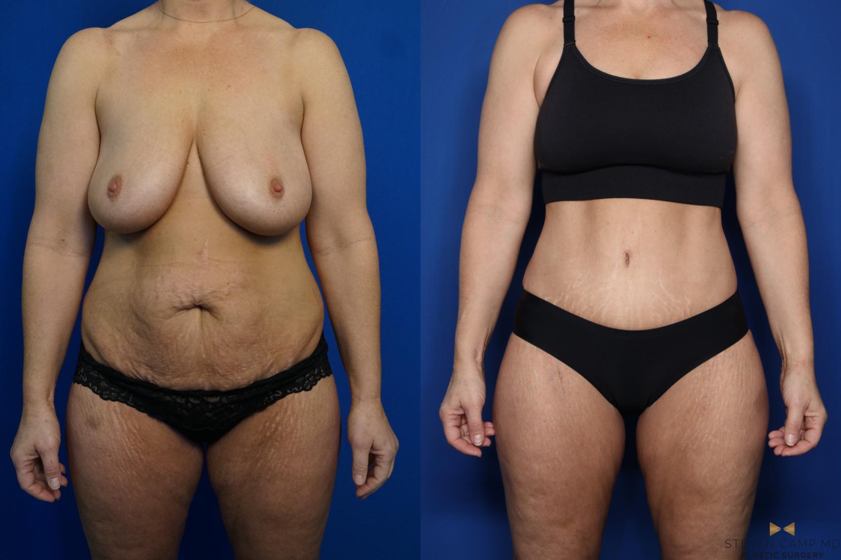 Before & After Tummy Tuck Case 437 Front View in Fort Worth, Texas