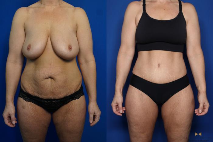 Before & After Tummy Tuck Case 437 Front View in Fort Worth & Arlington, Texas