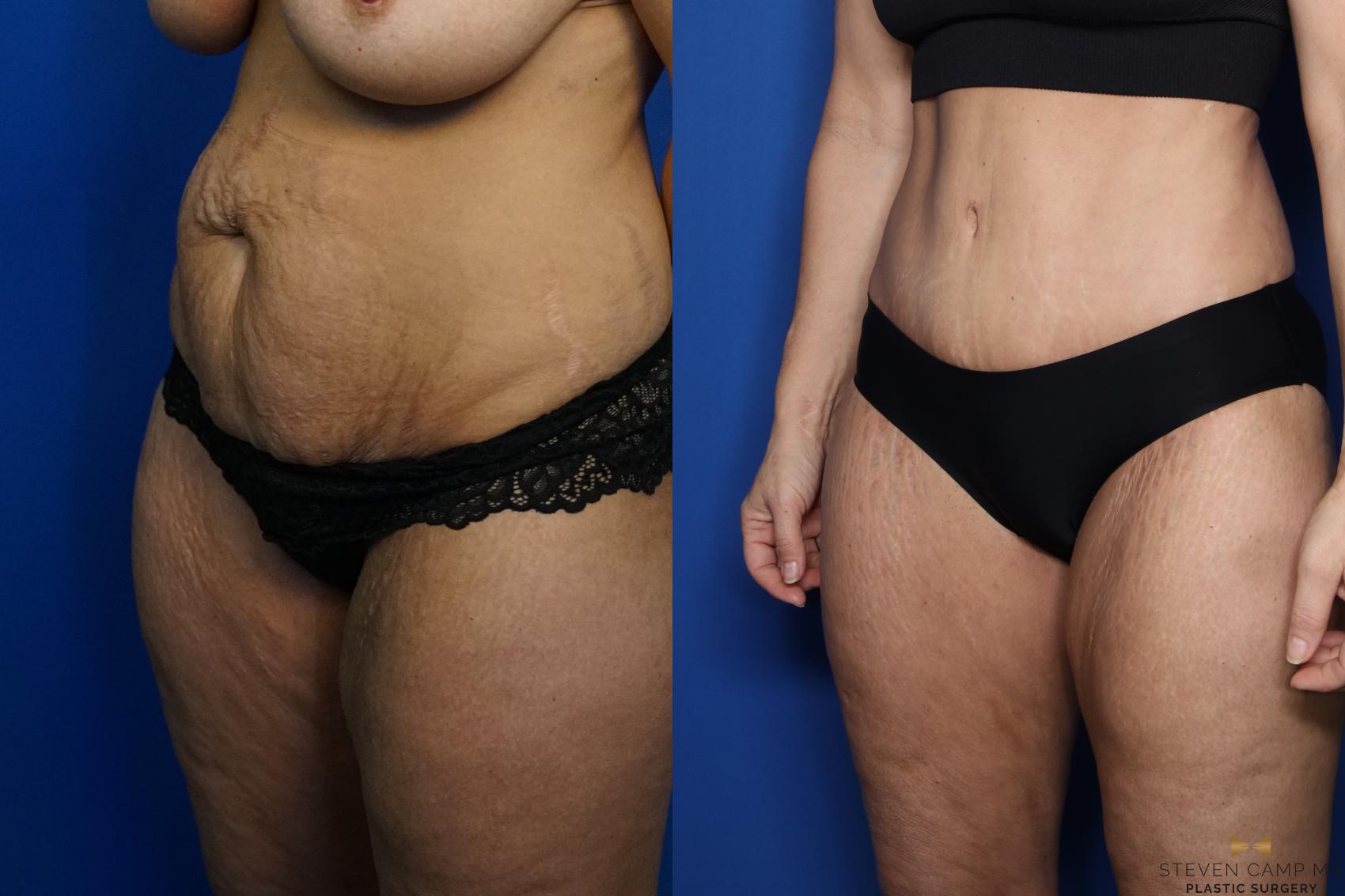 Before & After Tummy Tuck Case 437 Left Oblique View in Fort Worth, Texas