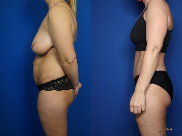 Before & After Tummy Tuck Case 437 Left Side View in Fort Worth & Arlington, Texas