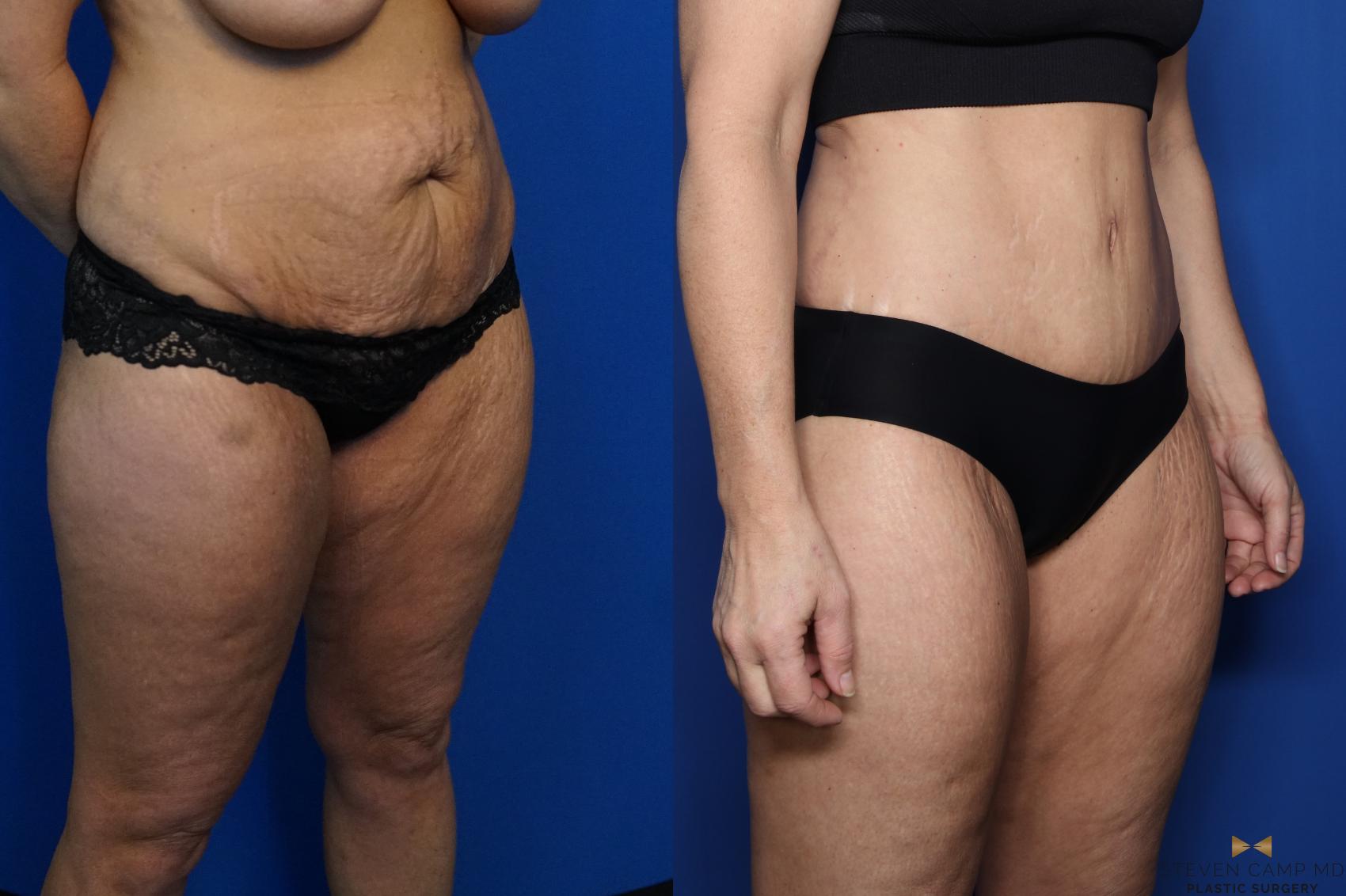 Before & After Tummy Tuck Case 437 Right Oblique View in Fort Worth, Texas
