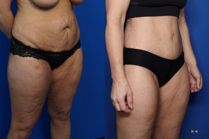 Before & After Tummy Tuck Case 437 Right Oblique View in Fort Worth & Arlington, Texas
