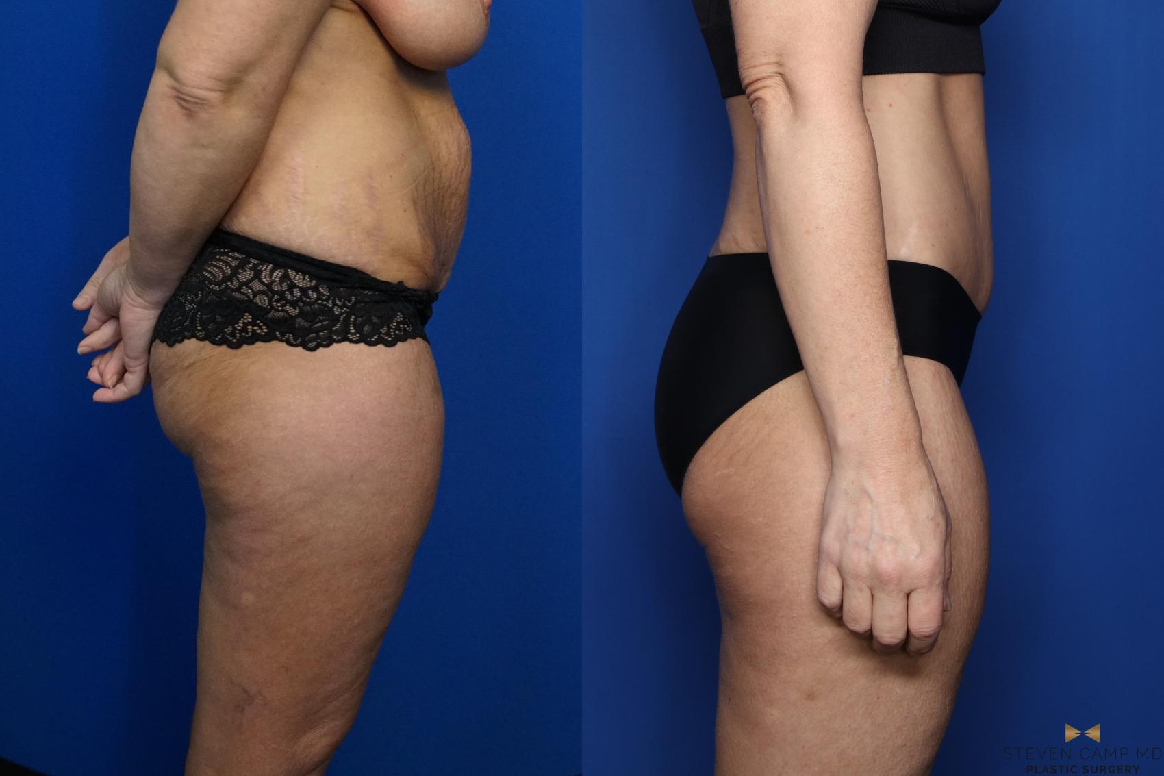 Before & After Tummy Tuck Case 437 Right Side View in Fort Worth, Texas