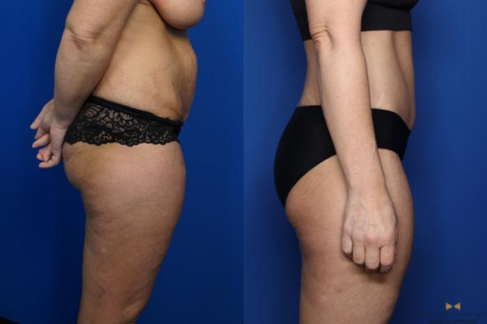 Before & After Tummy Tuck Case 437 Right Side View in Fort Worth & Arlington, Texas