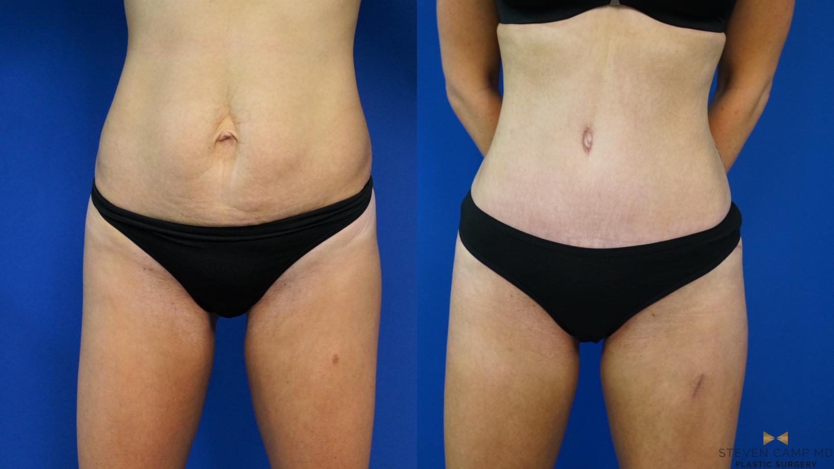 Before & After Tummy Tuck Case 460 Front View in Fort Worth & Arlington, Texas