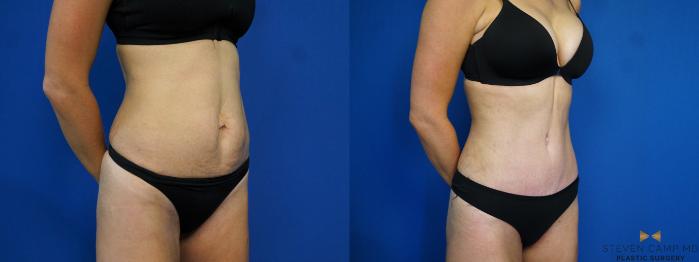 Before & After Liposuction Case 460 Right Oblique View in Fort Worth & Arlington, Texas