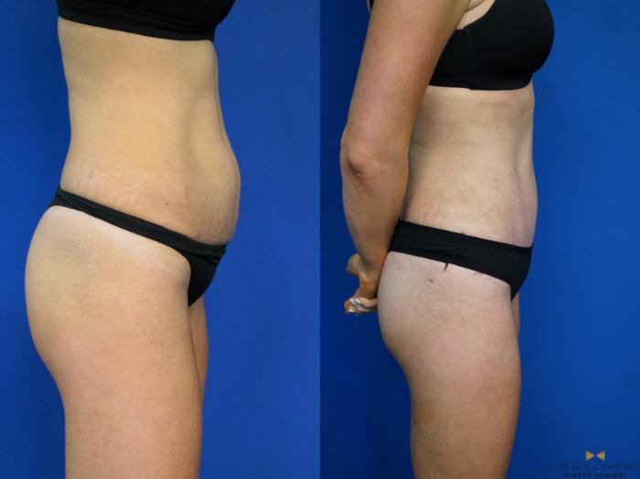 Before & After Liposuction Case 460 Right Side View in Fort Worth & Arlington, Texas